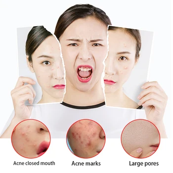 Anti-acne grietinėlė, pašalinti spuogus, šalinti inkštirus, balinimo priežiūros, remonto gelis, randų šalinimas, sumažinti spuogų, alyvos kontrolės odos priežiūra